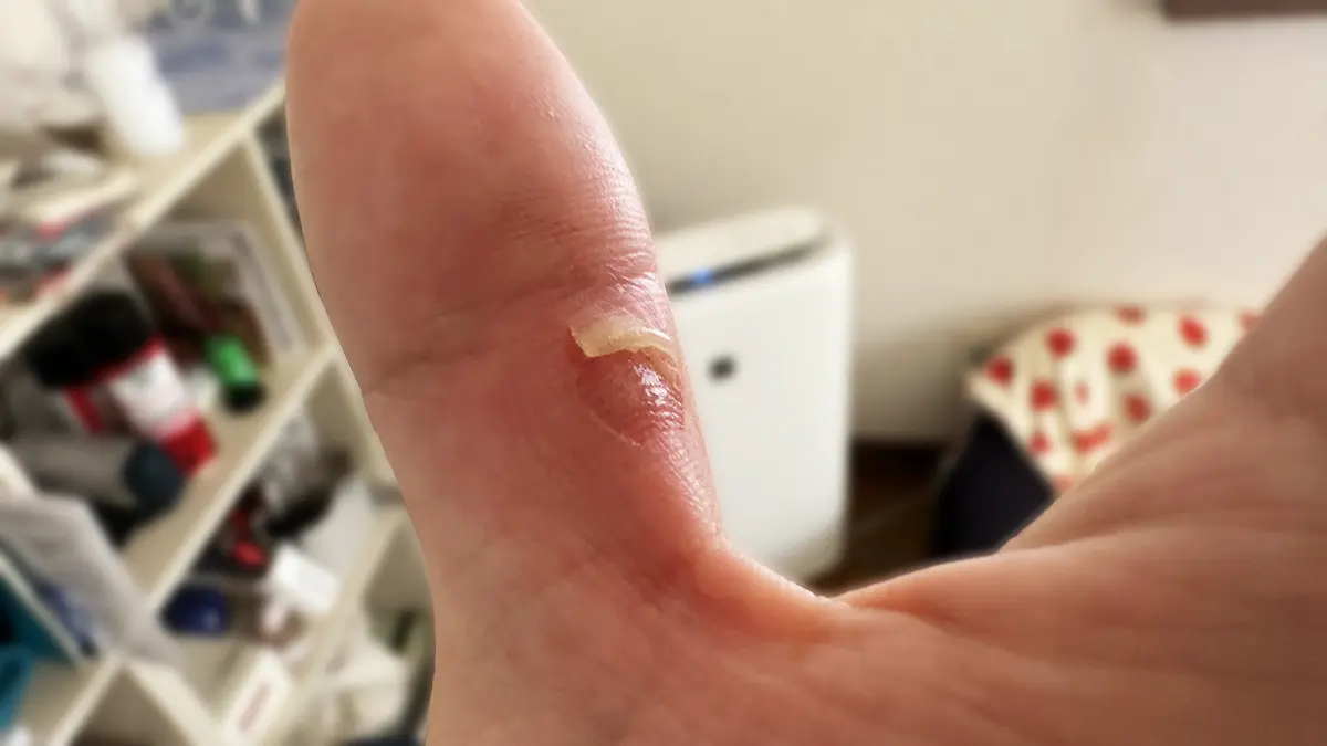 親指の付け根の水脹れ。